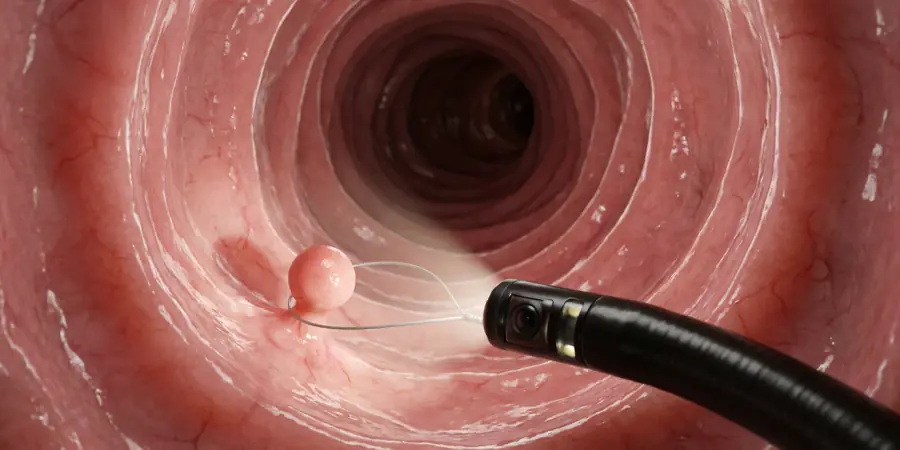 Ilustración de colonoscopia: colonoscopio revisando el interior del colon